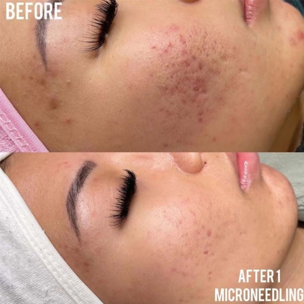 Warrenton's PRP Facelift & Pigment Treatments for Younger, Brighter Skin! | Vipon