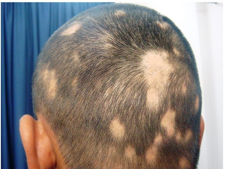 Best Doctors & Treatment for Hair Fall in India