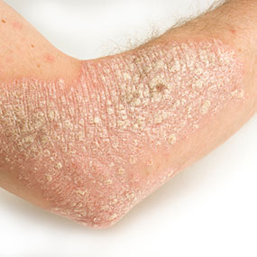 Best Homeopathy Treatment for Psoriasis of Different Types