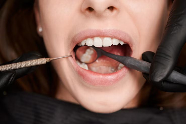 What Are My Options After Dental Extraction? Bridges vs. Implants - Free Guest Posting