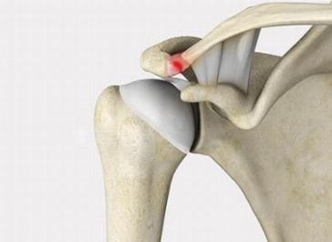 AC Joint Repair Treatment in Ranchi | Top Specialist for Shoulder