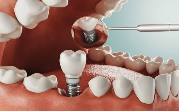 How Dental Implants Change Lives in Santa Clarita | Bridgeport Aesthetic Dentistry