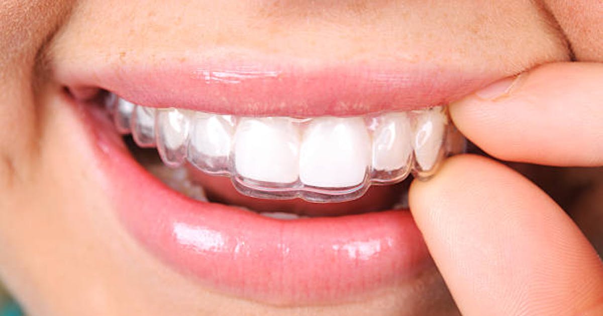 Invisalign Braces for Discreetly Straightening Your Teeth