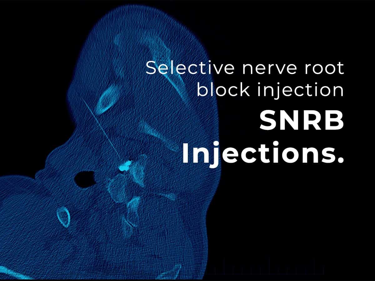 Selective Nerve Root Block (SNRB): Pain Relief Therapy