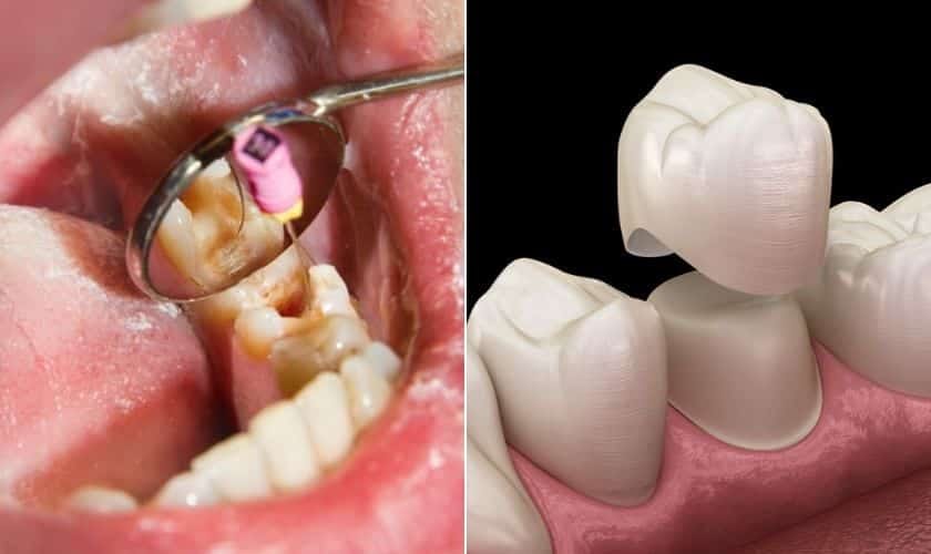 Understanding Root Canals: Causes, Symptoms, and When You Need One | by Roja Arjun | Jan, 2025 | Medium