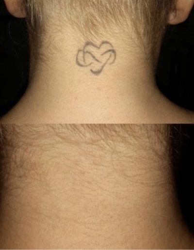 Tattoo Removal Before and After – See the Difference