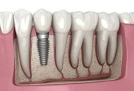 How Long Do Dental Implants Take to Settle Down? | Buzzy