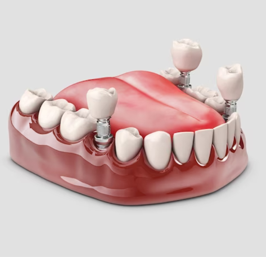 Dental Crowns In Al Ain | Best Dental Crowns & Bridges UAE