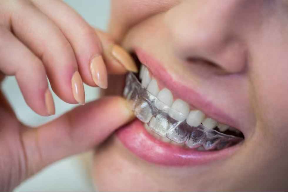 Dental Retainers In Al Ain | Best Dental Retainers UAE