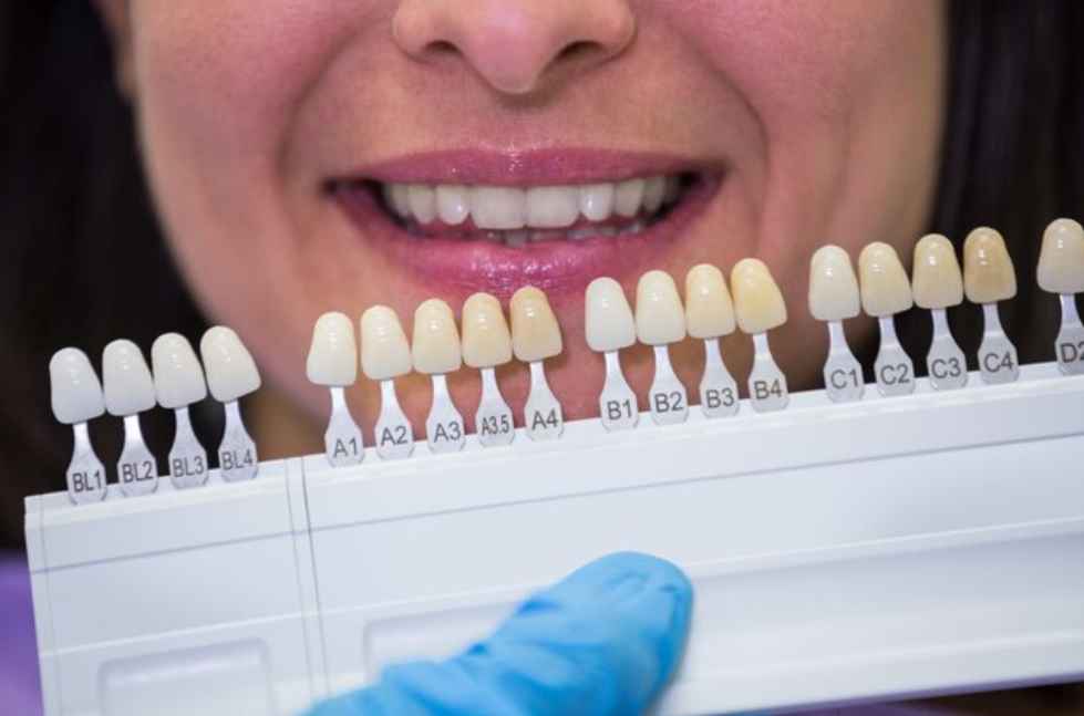 Veneers In Al Ain | Dental Veneers Treatment In Al Ain