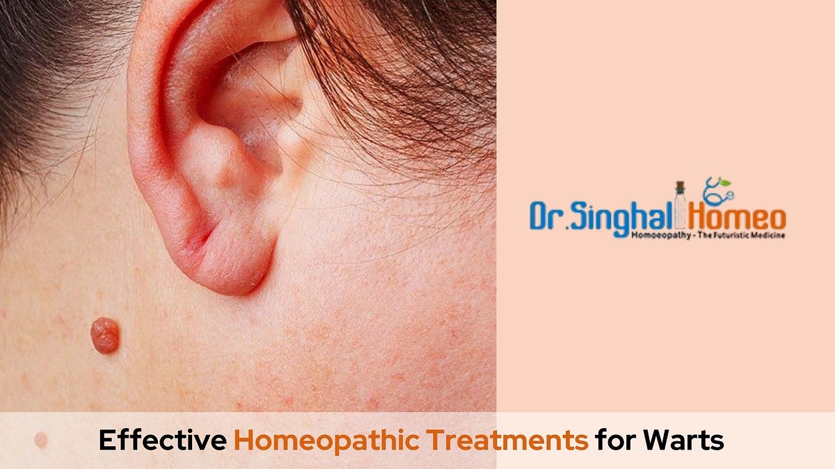 Warts Homeopathy Medicine: A Natural Approach to Treatment | by Dr. Singhal Homeo | Feb, 2025 | Medium