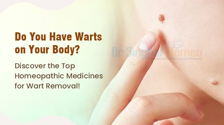 Discover the Top Homeopathic Medicines for Warts