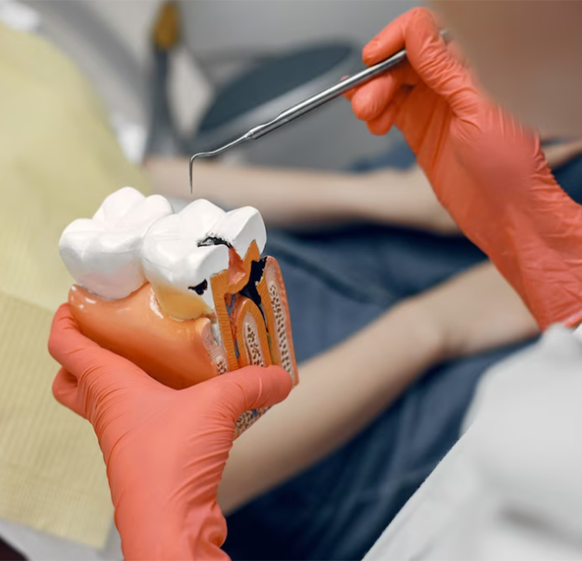 Root Canal Treatment In Al Ain | Best Root Canal Treatment