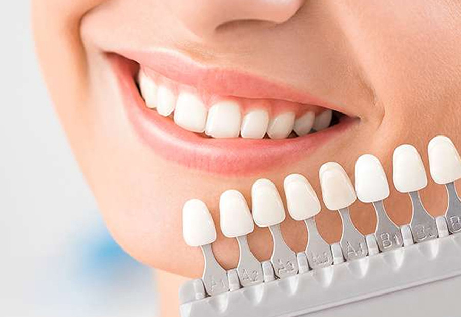 Dental Veneers Abu Dhabi | Best Dental Veneers Treatment UAE