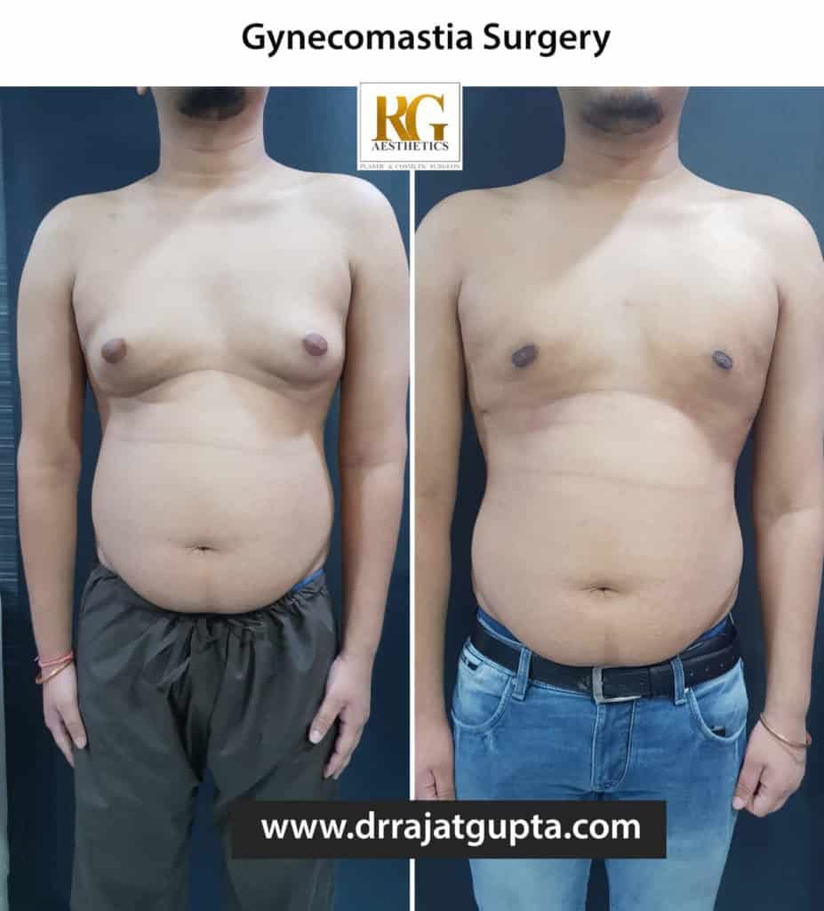 Choosing the Right Surgeon for Your Gynecomastia Procedure | by drrajatgupta | Mar, 2025 | Medium