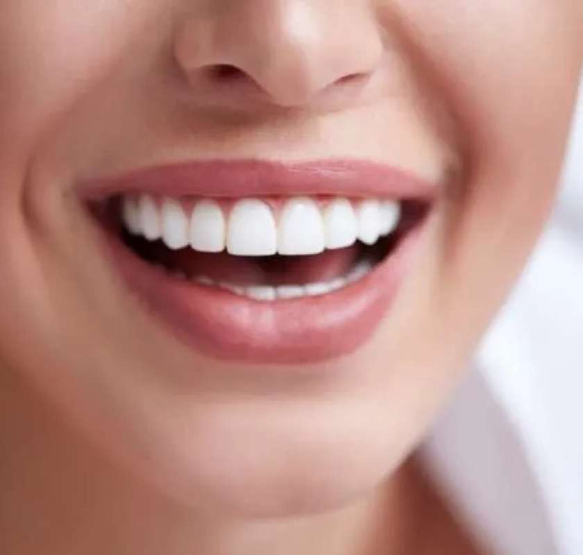 Dental Veneers Sydney | Composite Resin Sydney