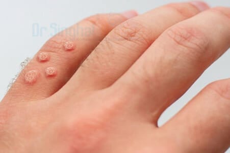 Find the Best Homeopathic Doctor for Warts Treatment