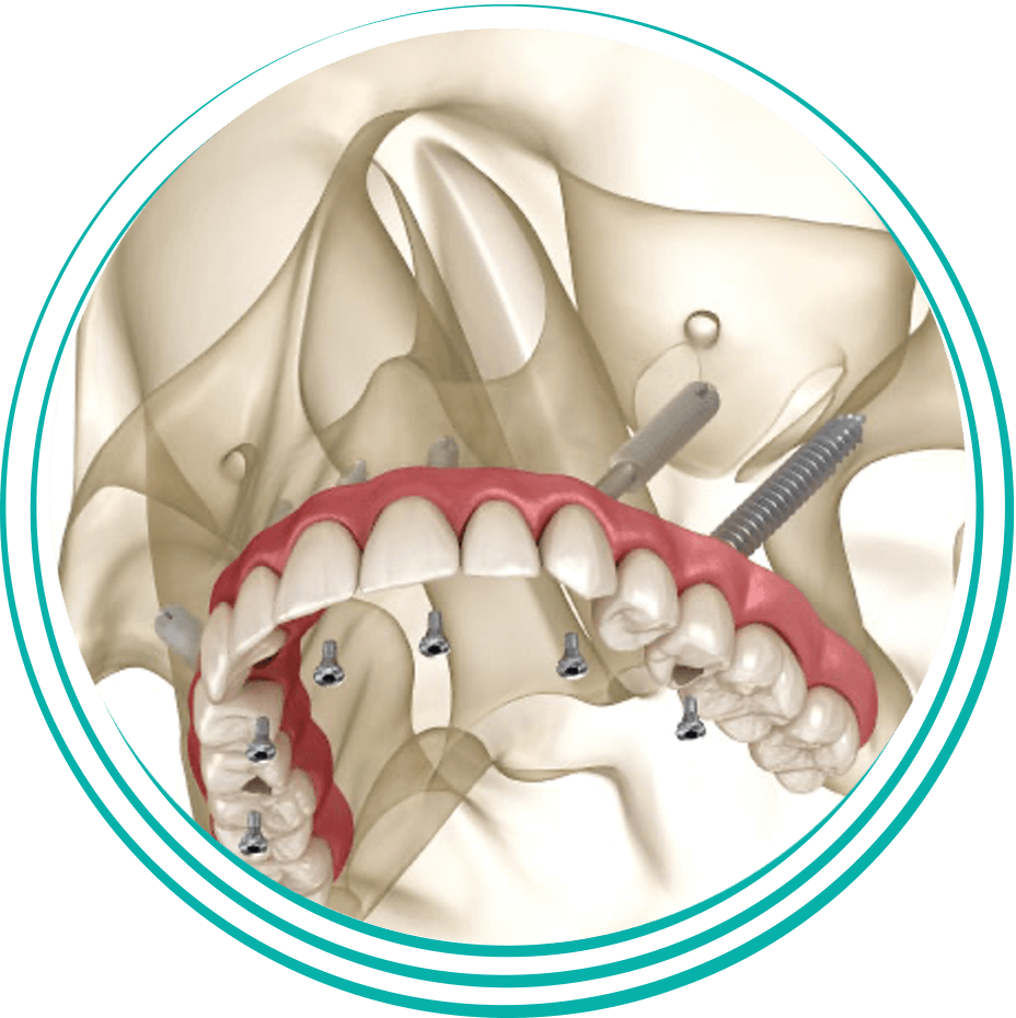 Top Benefits of Zygomatic Dental Implants in Nashville for Severe Bone Loss - Press Release Submission Sites Free, Free Instant Approval Guest Posting Sites