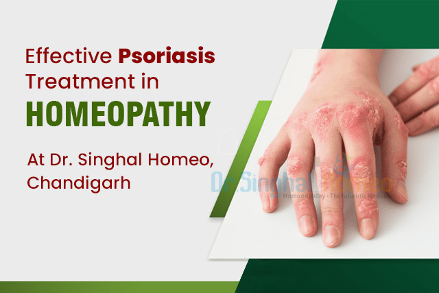 Homeopathic Medicines for Psoriasis Treatment: A Comprehensive Guide – health
