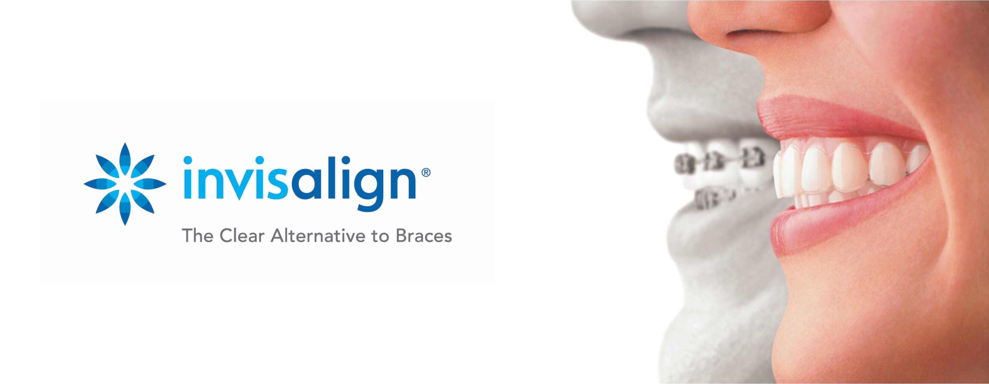 Invisalign Los Angeles | Orthodontic Services | Personal Dental Office